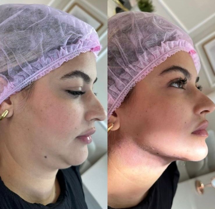 Antes e depois da lipo de papada enzimática